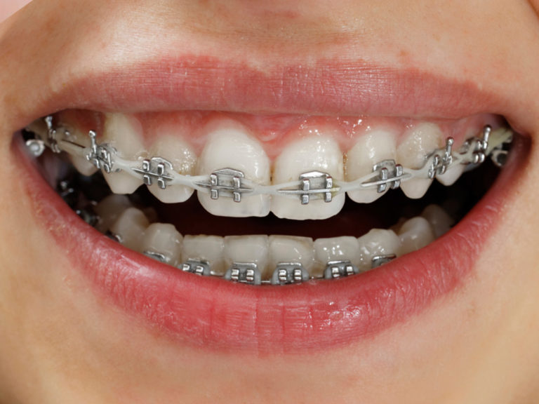 Braces Orthordontics In South Fort Worth And Arlington Abram Dental